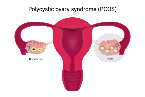 Hello IVF：三代试管婴儿可以筛查白内障遗传病吗